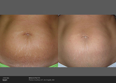 before and after stretch mark treatment